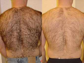 depilacion laser masculina antes despues depilacion laser masculina antes despues