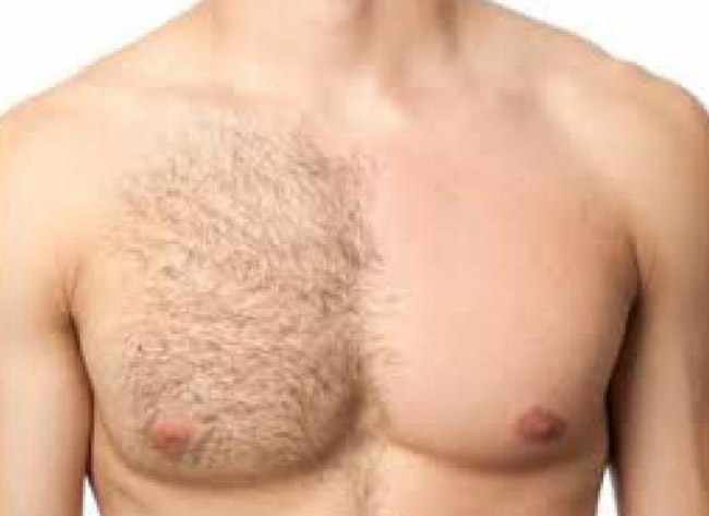 depilacion masculina laser depilacion masculina laser