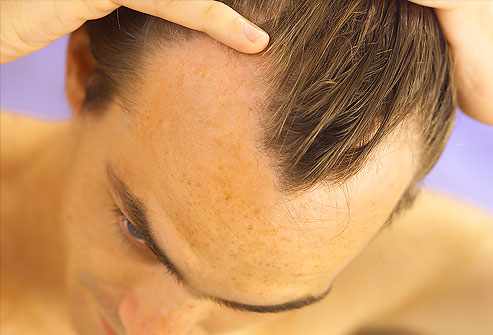 caída del cabello hombres