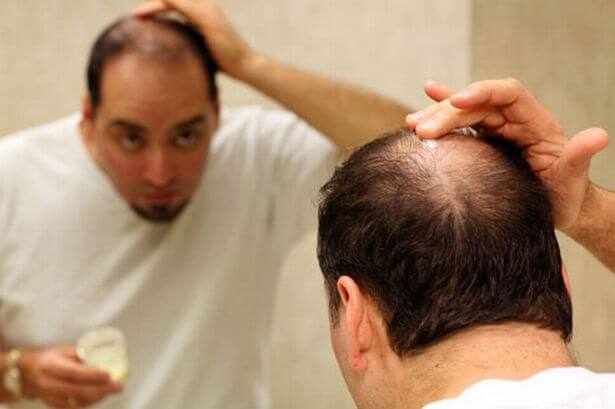 remedios naturales para la caida del cabello en hombres