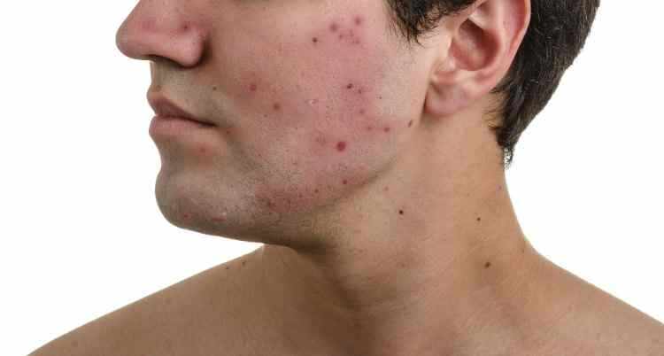 remedios efectivos para el acne